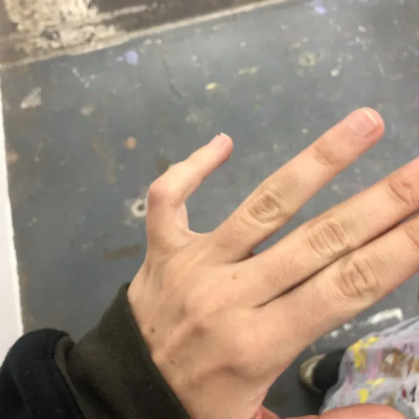 Broken finger