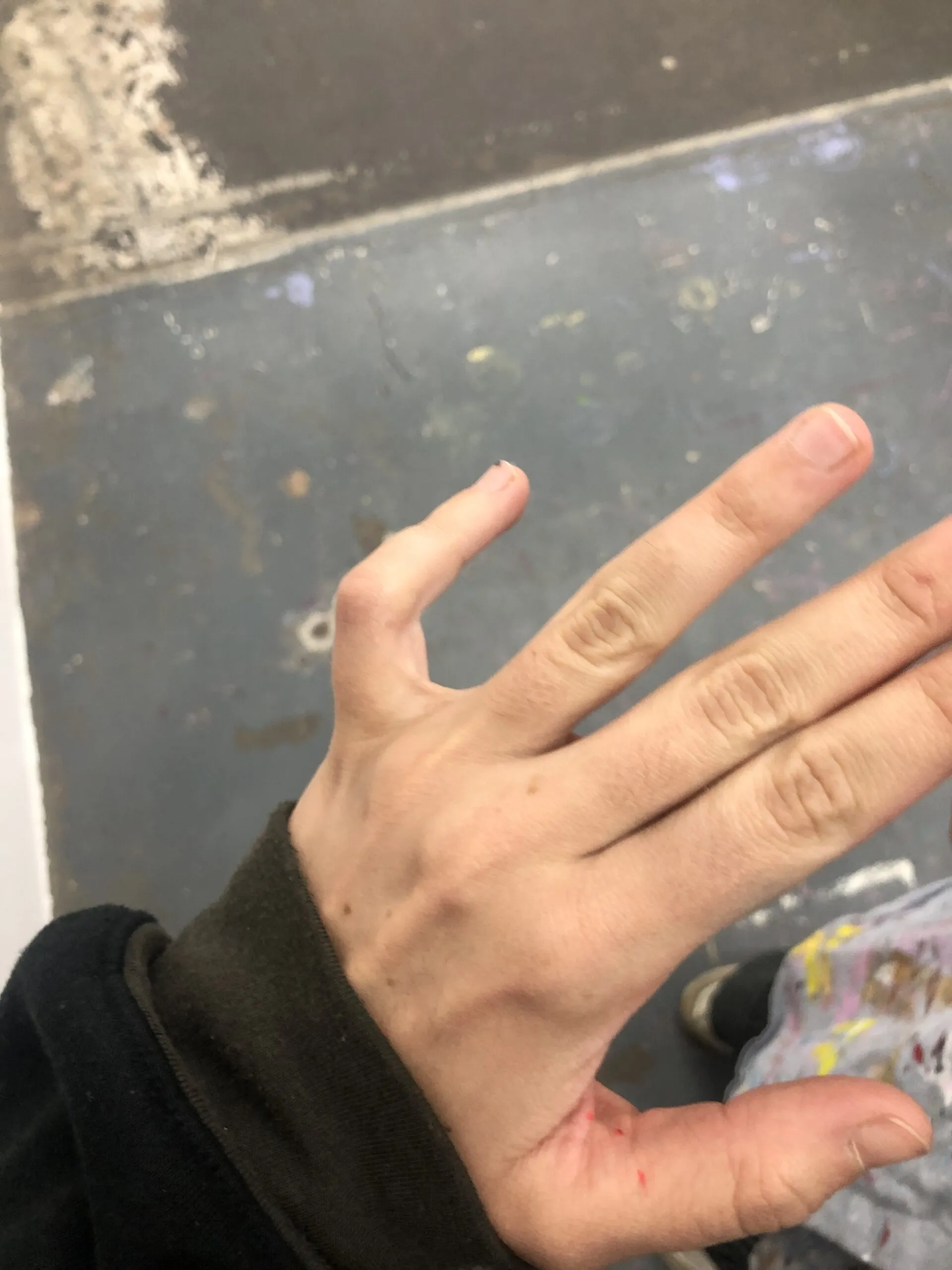 Broken finger